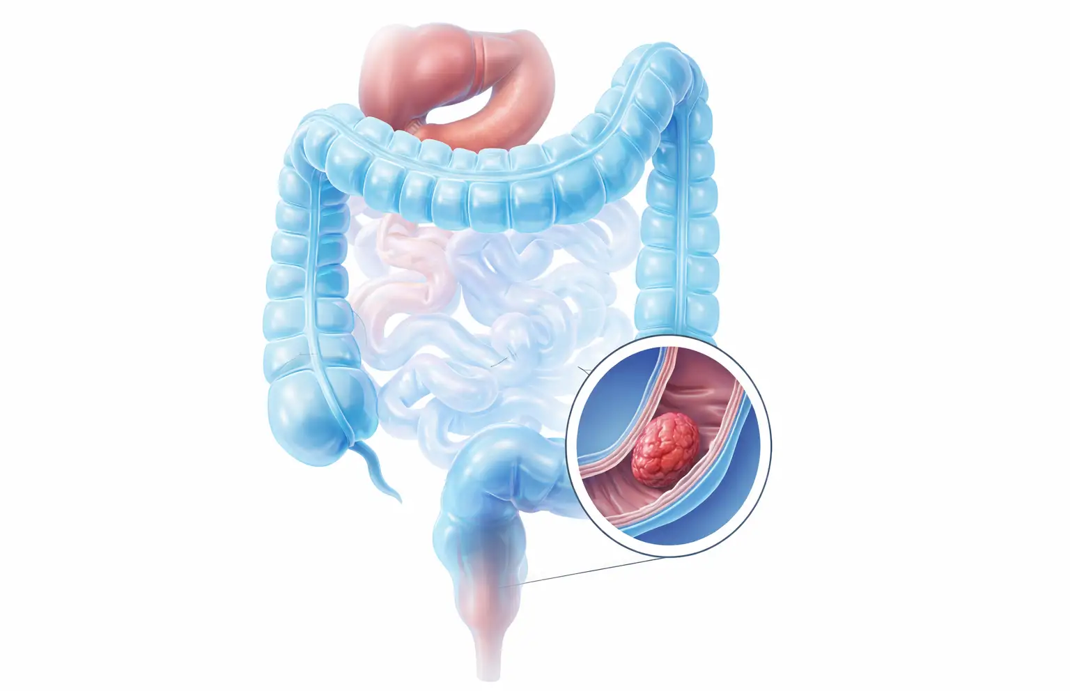 Rak debelog creva: Simptomi, uzroci i važnost prevencije