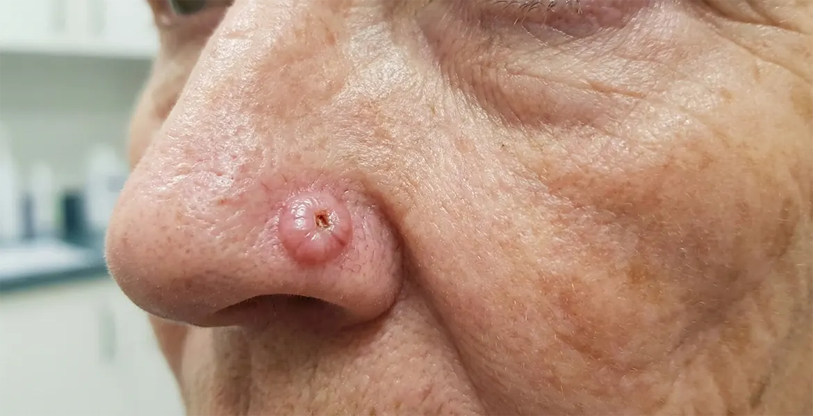 Karcinom bazalnih ćelija na beloj koži