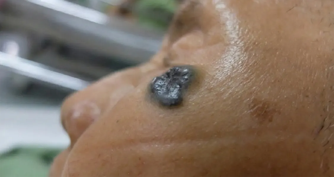 Karcinom bazalnih ćelija na smeđoj koži