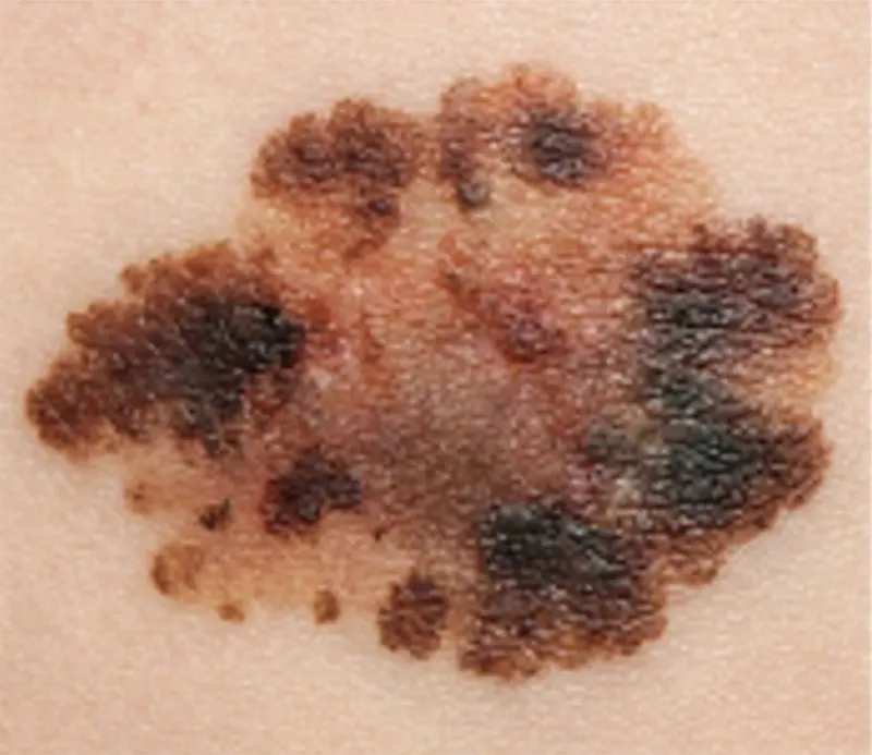 Melanom - tamna asimetrična mrlja na koži