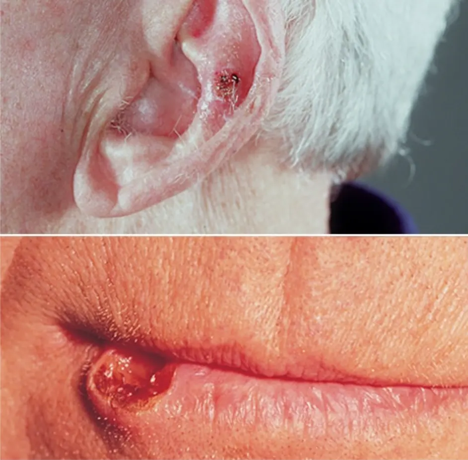 Karcinom skvamoznih ćelija kože